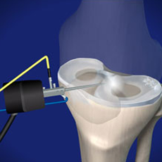 meniscus repair