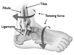 ankle fractures in children